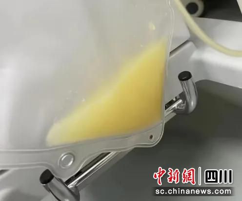 “牛奶血”。成婦兒醫院供圖 “牛奶血”。成婦兒醫院供圖